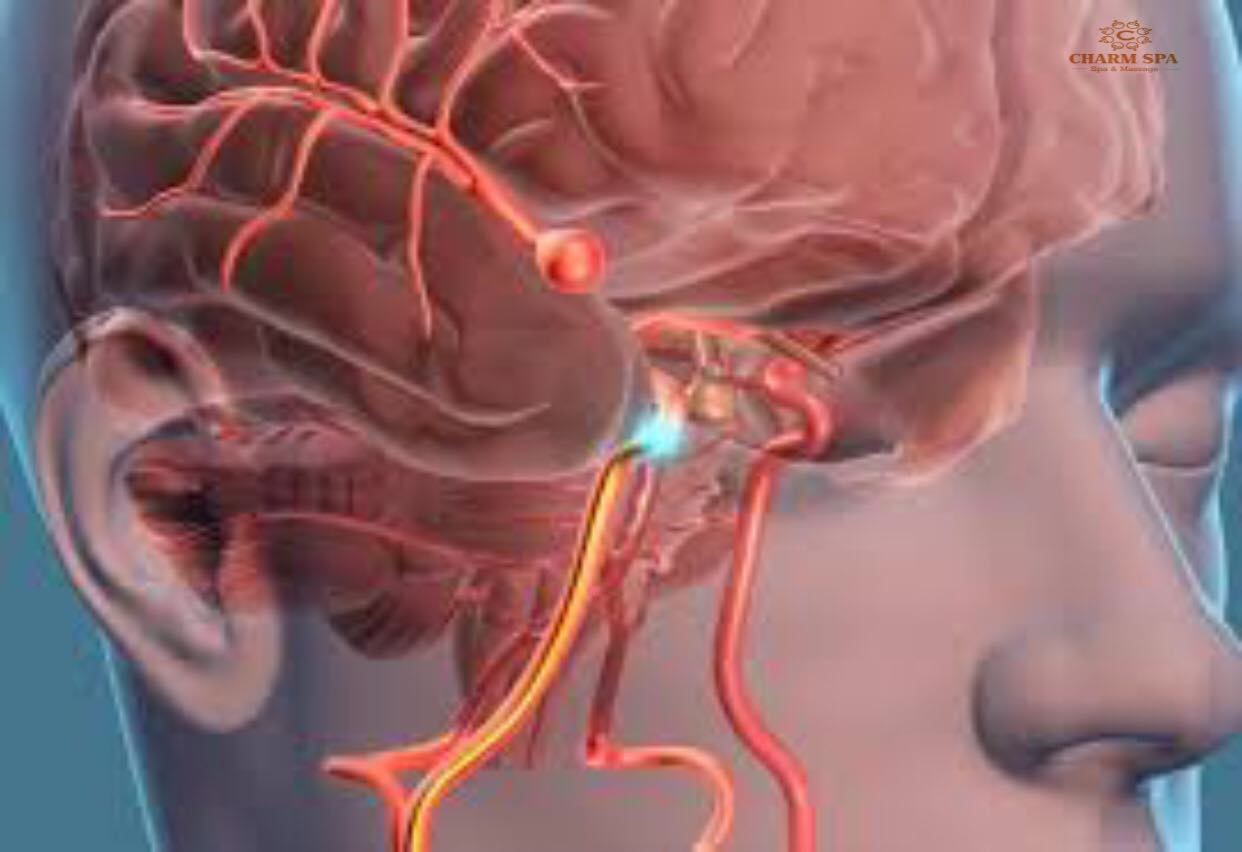 Đột quỵ xảy ra khi máu lên não bị gián đoạn